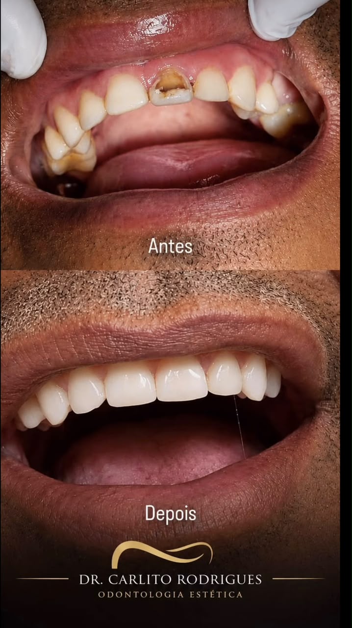 Caso real de Facetas em Resina — Dr. Carlito Rodrigues