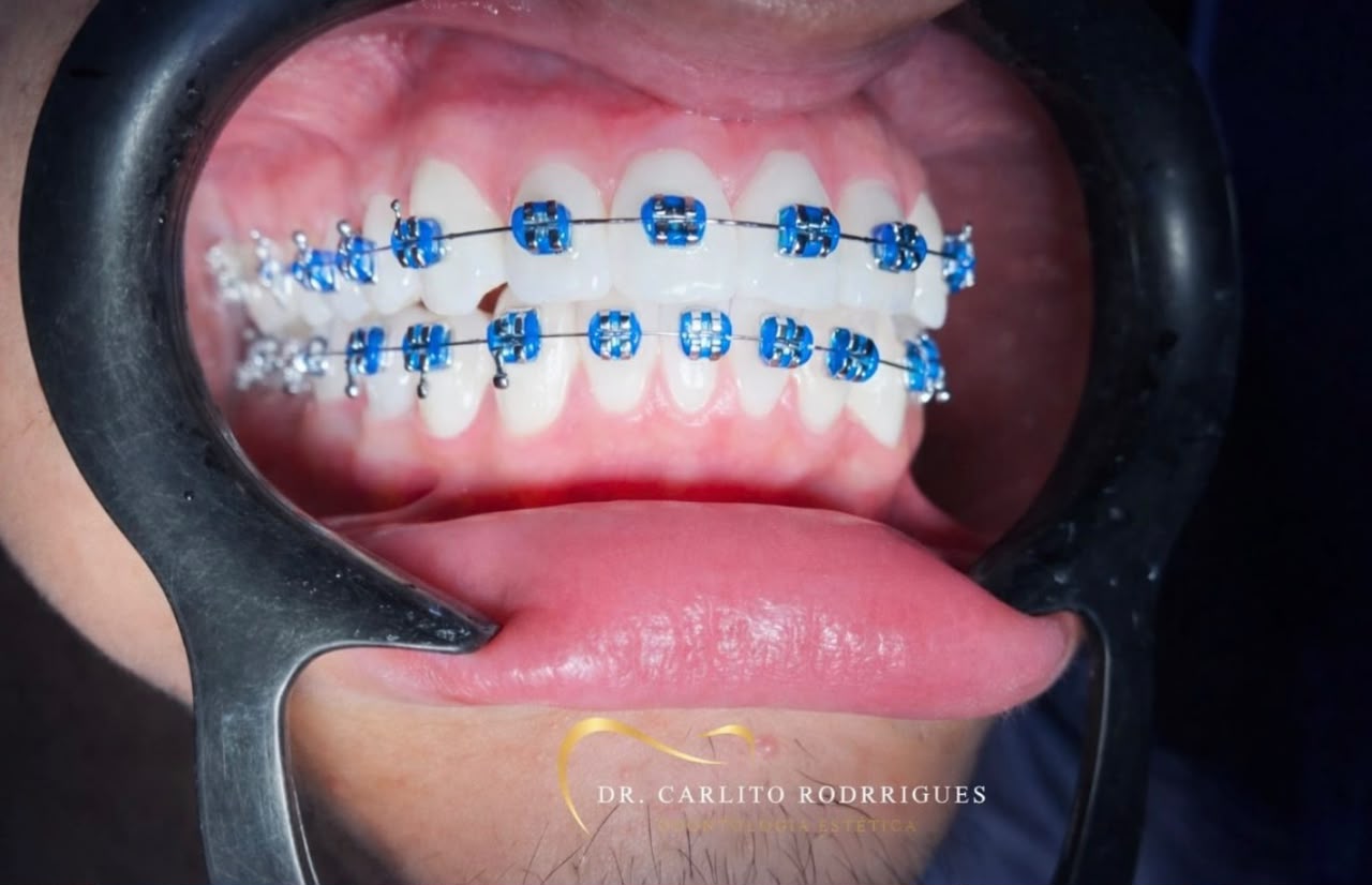 Caso real de Tratamento Ortodôntico — Dr. Carlito Rodrigues