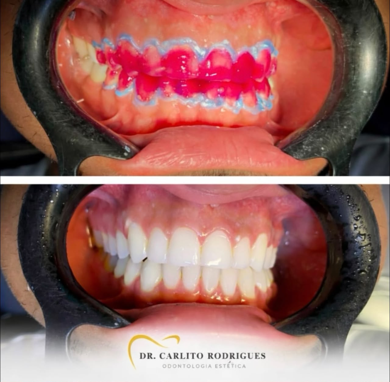 Caso real de Clareamento Dentário — Dr. Carlito Rodrigues